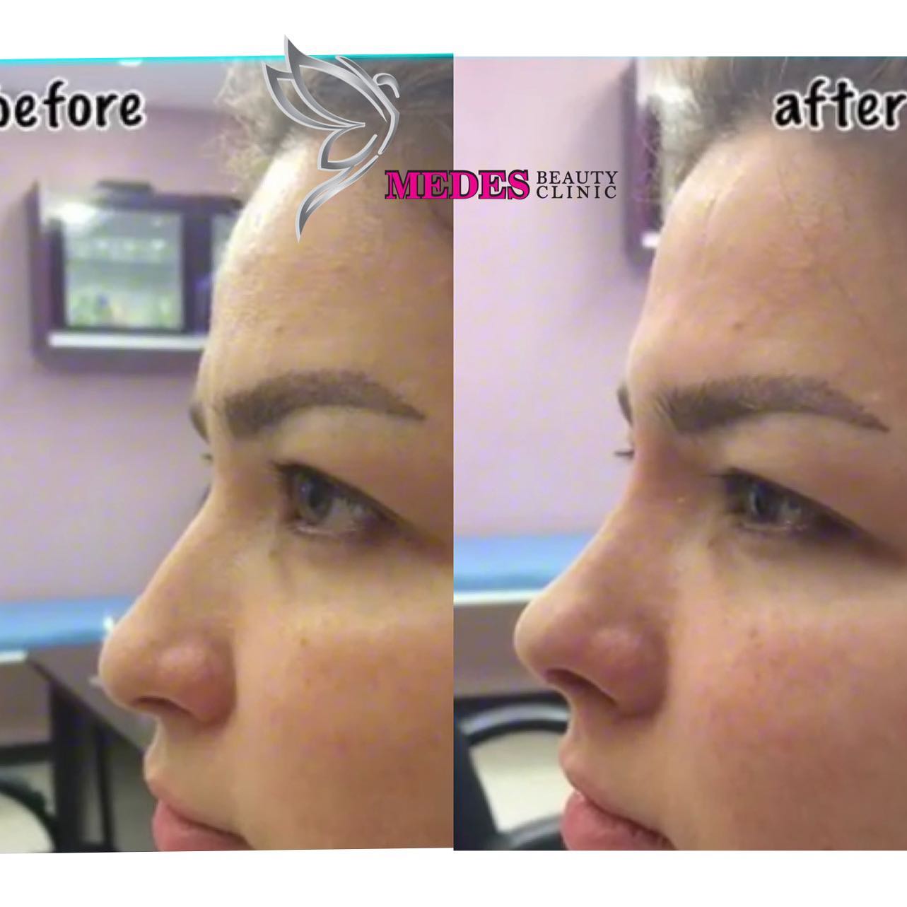 گالری لیفت با نخ